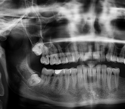 Radiografia odontológica